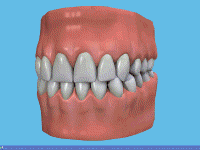 [Animation - tooth falling out because of pocketing
