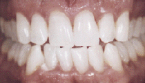 [After Whitening]