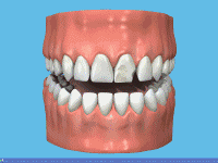 Animation of the procedure to attach a crown to a broken front tooth