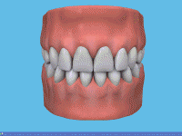 [Animation of root canal treatment procedure]